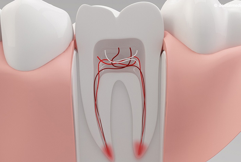 soins-dentaires-marrakech-Endodontie