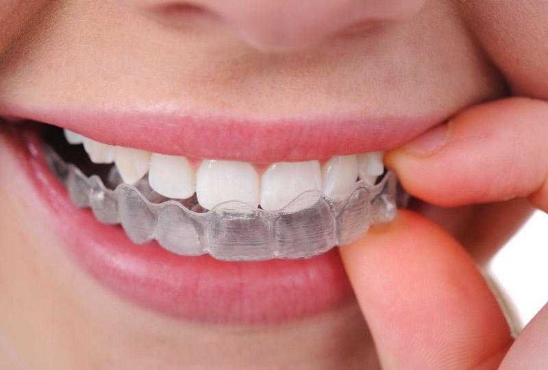 Conseils pour le port des gouttières orthodontiques